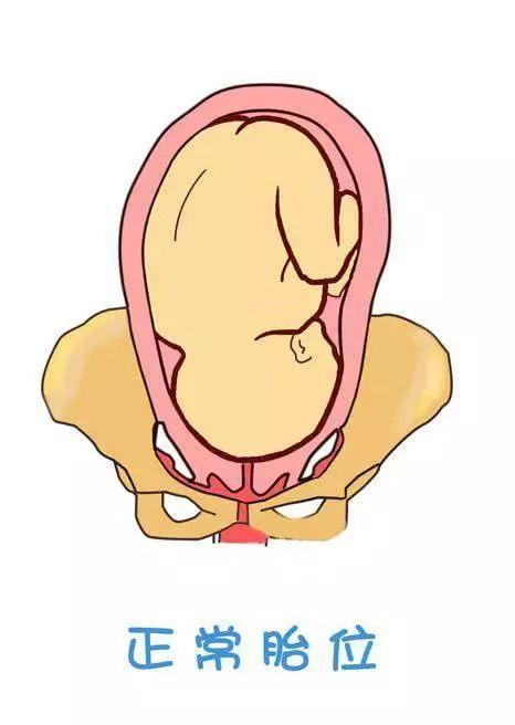 胎位不正做什么操可以纠正胎位,胎位不正如何纠正胎位