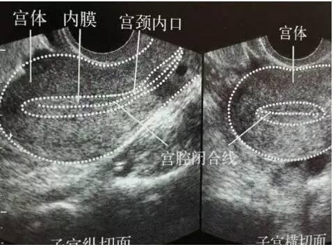 单角子宫怀孕三次自然流产,连续胎停育三次检查没问题
