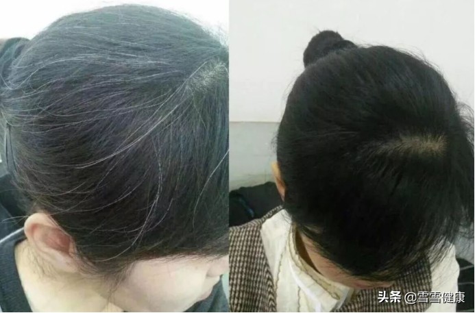 少年白是身体不行了吗,少年白有什么方法改善