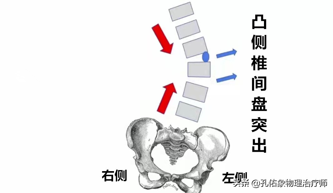 腰疼脊柱侧弯是什么样,腰痛引起的脊柱侧弯原因