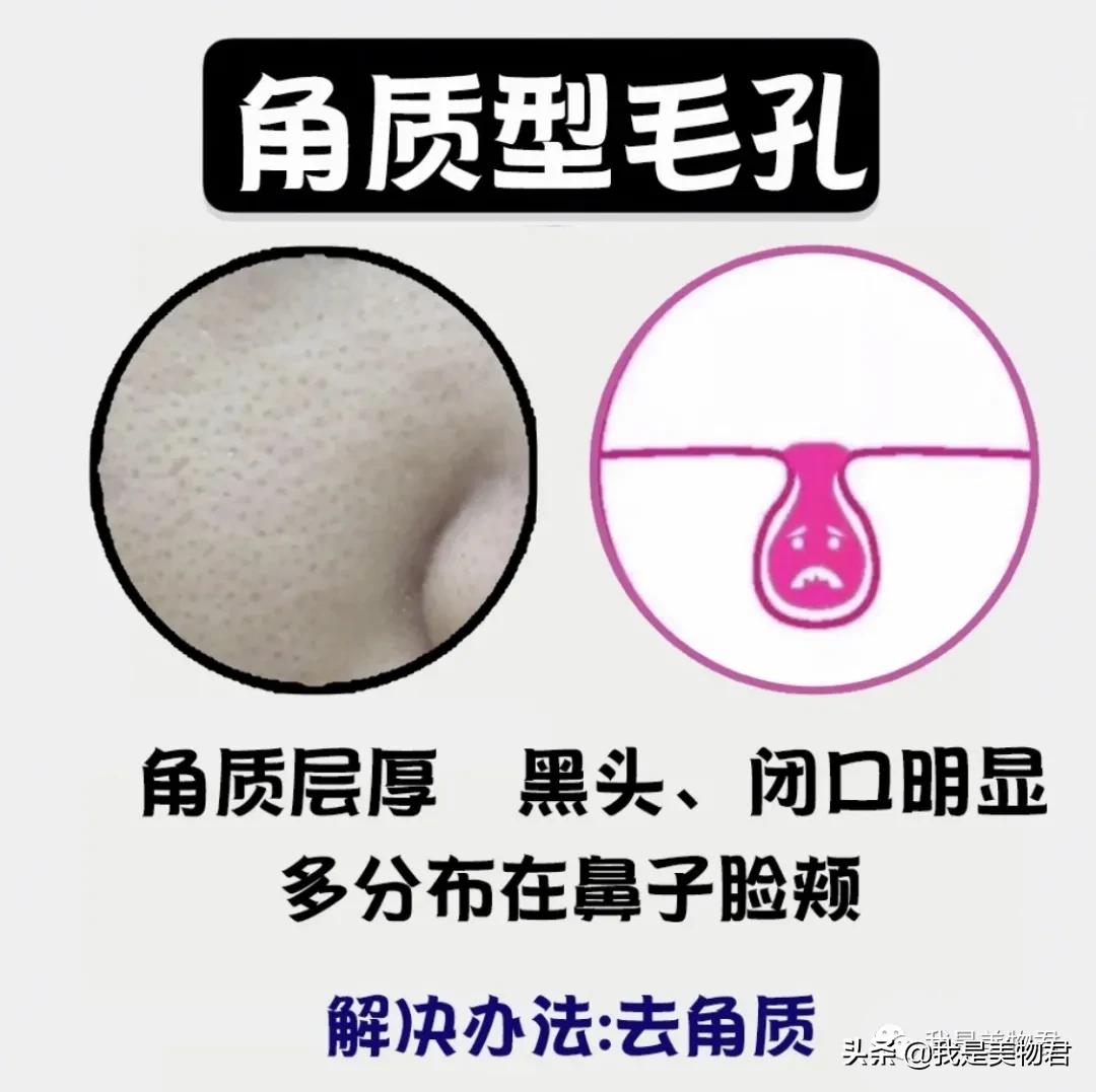 胸口毛孔粗大是什么原因,皮肤粗糙暗沉毛孔粗大什么原因