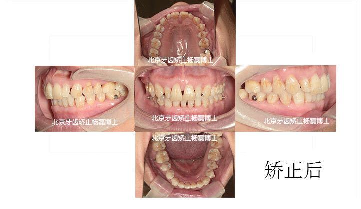 杨磊正畸医生,牙周病牙龈萎缩正畸案例