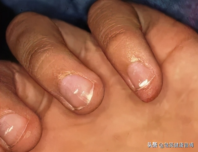 指甲出现各种问题的图片,指甲出现这些症状可能是灰指甲