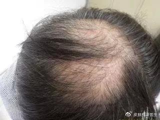 移植毛发真的有效吗,毛发移植能维持多久