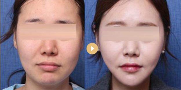 双下巴，嘟嘟肉，成年人的婴儿肥到底该肿么办？