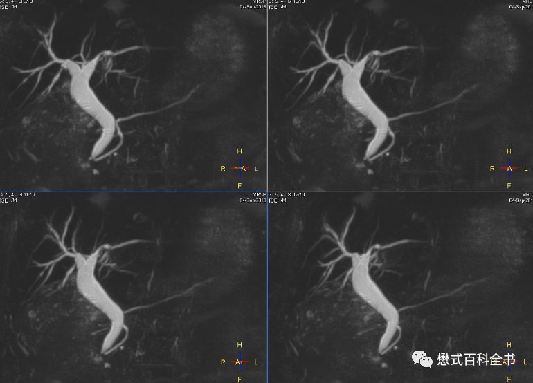 开展mrcp技术,mrcp检查操作流程