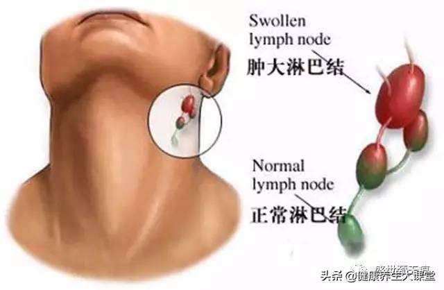 颈部淋巴堵该怎么排毒,淋巴毒素堆积的危害