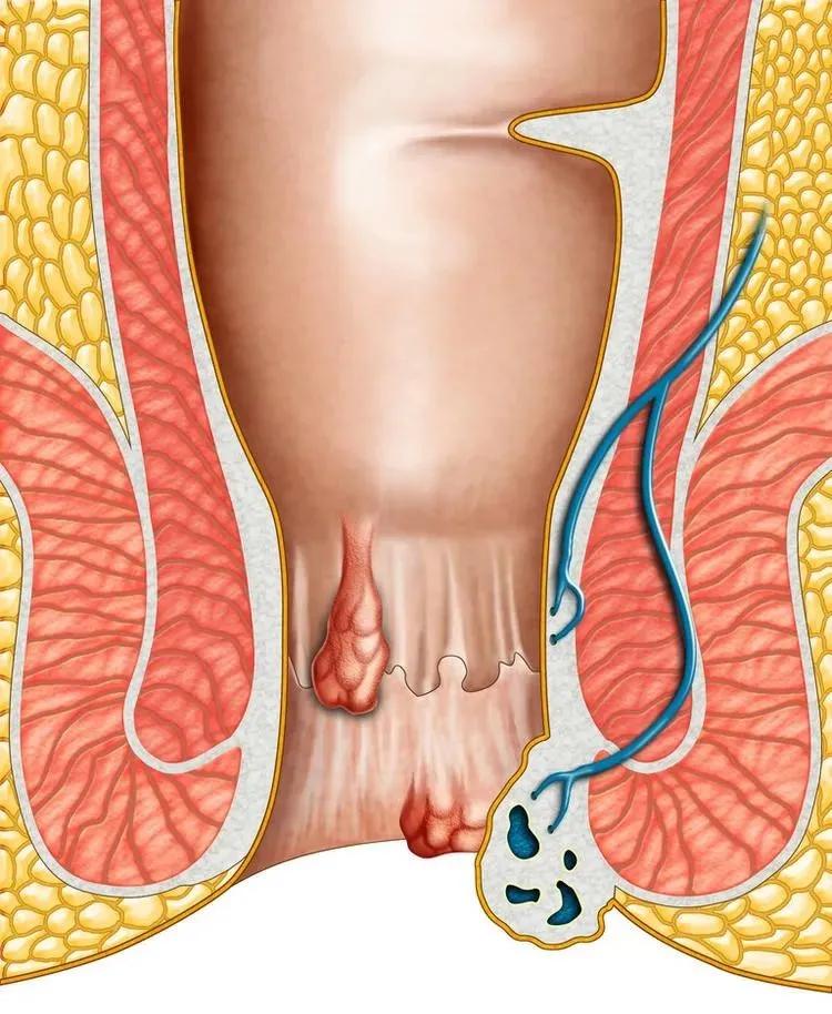 肛周小肉球,如何消除肛周的小肉球