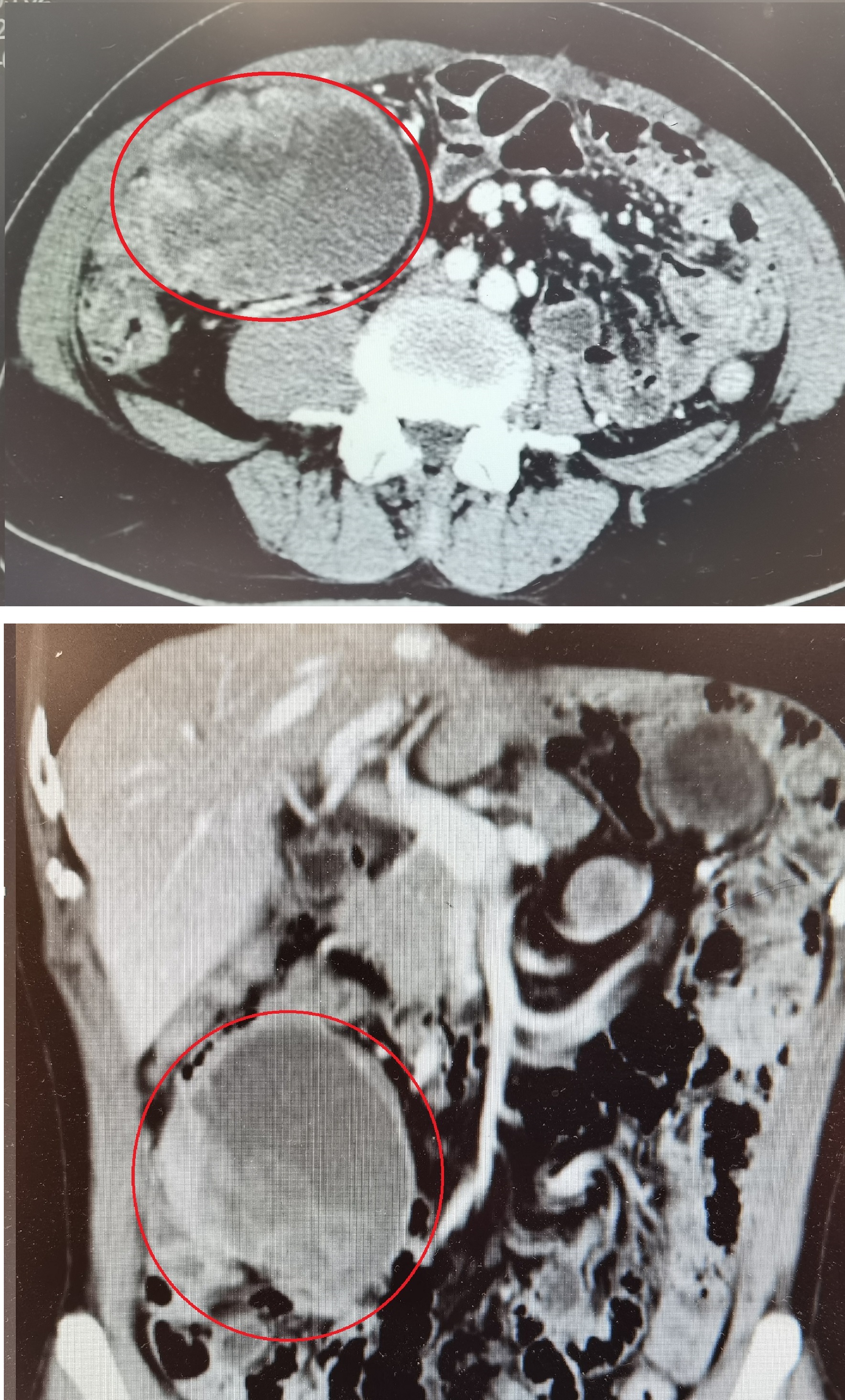胃间质瘤23例,和胃间质瘤对抗的12年