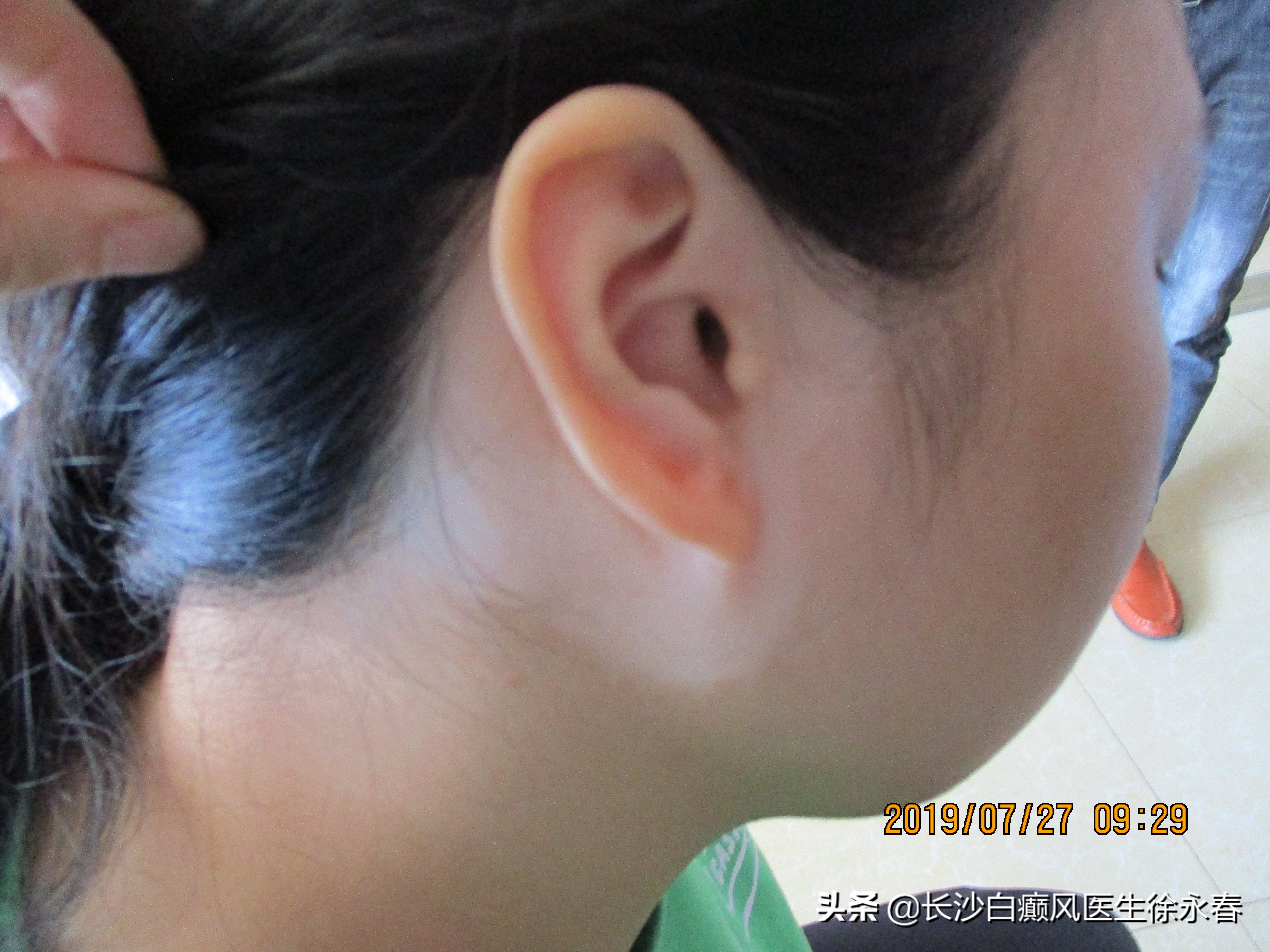 因为脸上白癜风，他们嫌弃我，担心传染怕影响后代