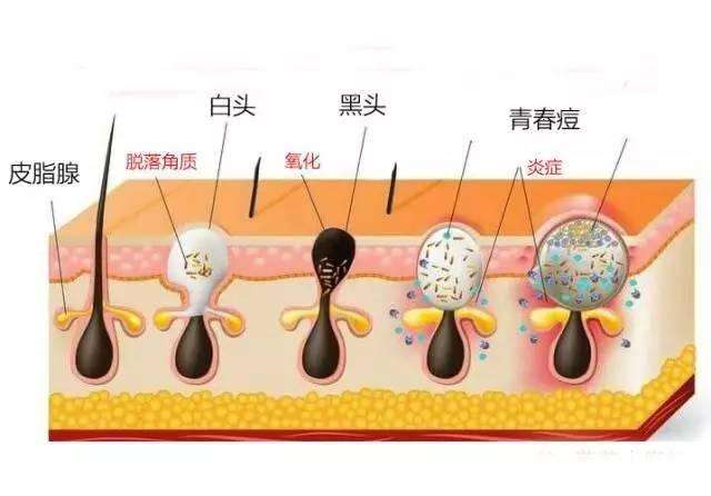 去黑头收缩毛孔简单有效方法,想要去黑头收缩毛孔用什么