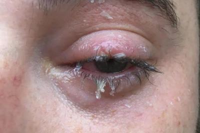 502误当眼药水,宝宝误把502胶水当成眼药水