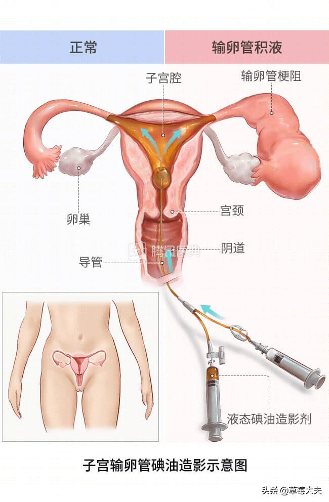 医生也成“催生婆”？不！是你输卵管出问题了......