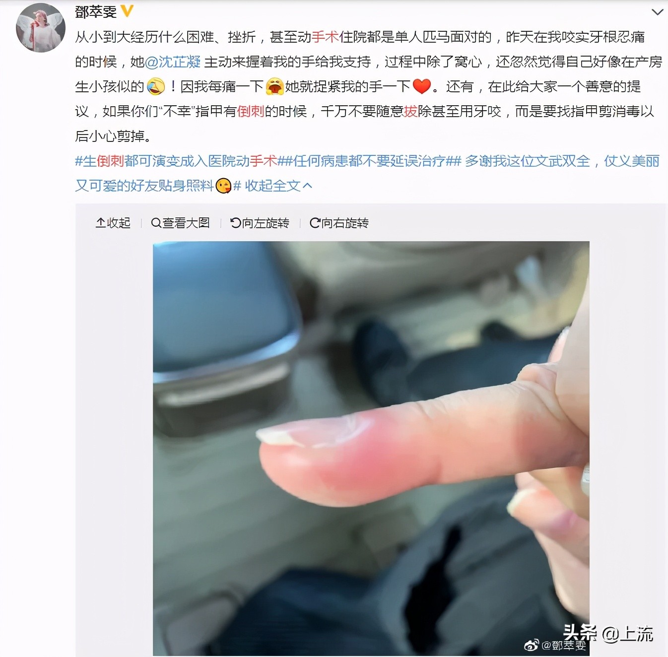 为什么总是忍不住拔倒刺,为什么会忍不住撕倒刺