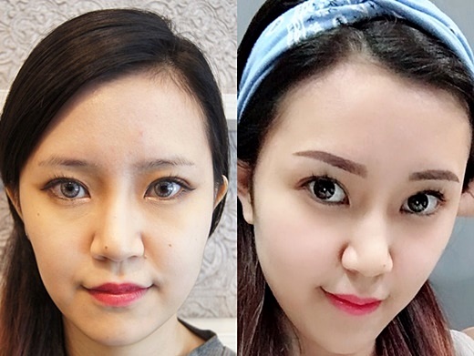 激光洗红眉的操作方法视频,红眉能激光吗