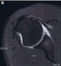 所有骨折都叫什么名字,骨折的名称有哪些