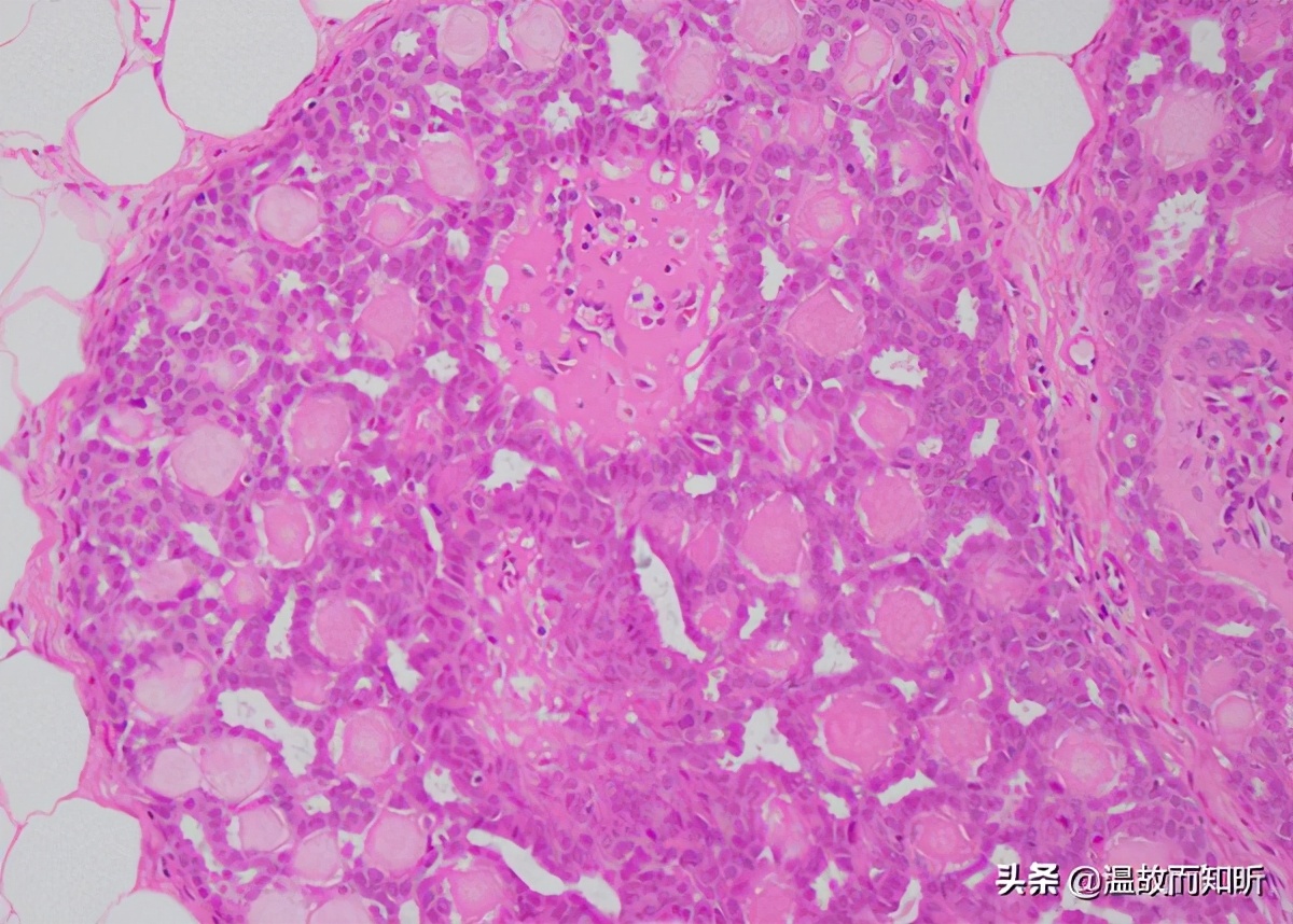 “不期而至”的乳头溢液，我该爱你还是恨你？