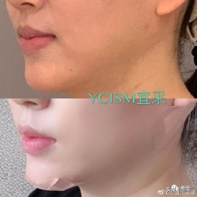 迷死氧亲身体验，我在日本吸掉了一桶脂肪和半张脸