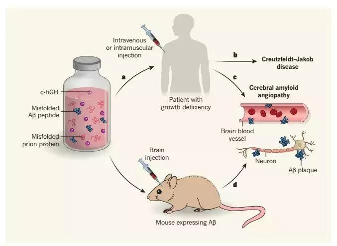 阿尔茨海默论文,检测阿尔茨海默症最新研究
