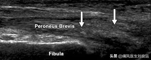 痛风膝关节积液冷敷还是热敷,急性痛风冷敷可以吗