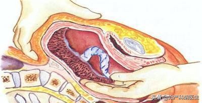 徒手剥离胎盘失败一定要清宫吗,徒手剥离胎盘操作流程