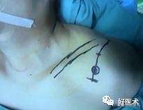 肩锁关节脱位手术后多久可以喝酒,肩锁关节脱位钢板内固定步骤记录