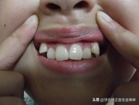 虎牙齿怎么矫正,有老虎牙怎么办