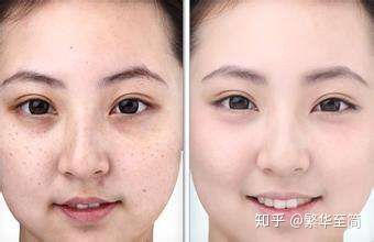 怎样消除脸上的色斑,点斑后脸上色斑越来越多