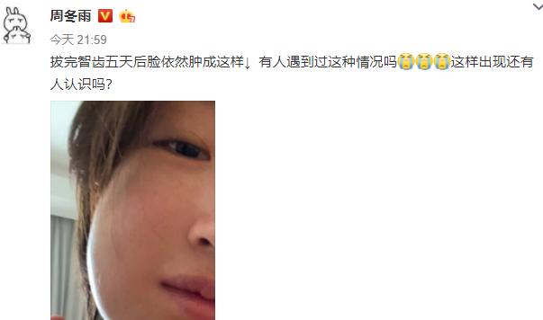 周冬雨拔的是哪颗智齿,周冬雨拔智齿脸肿成了表情包