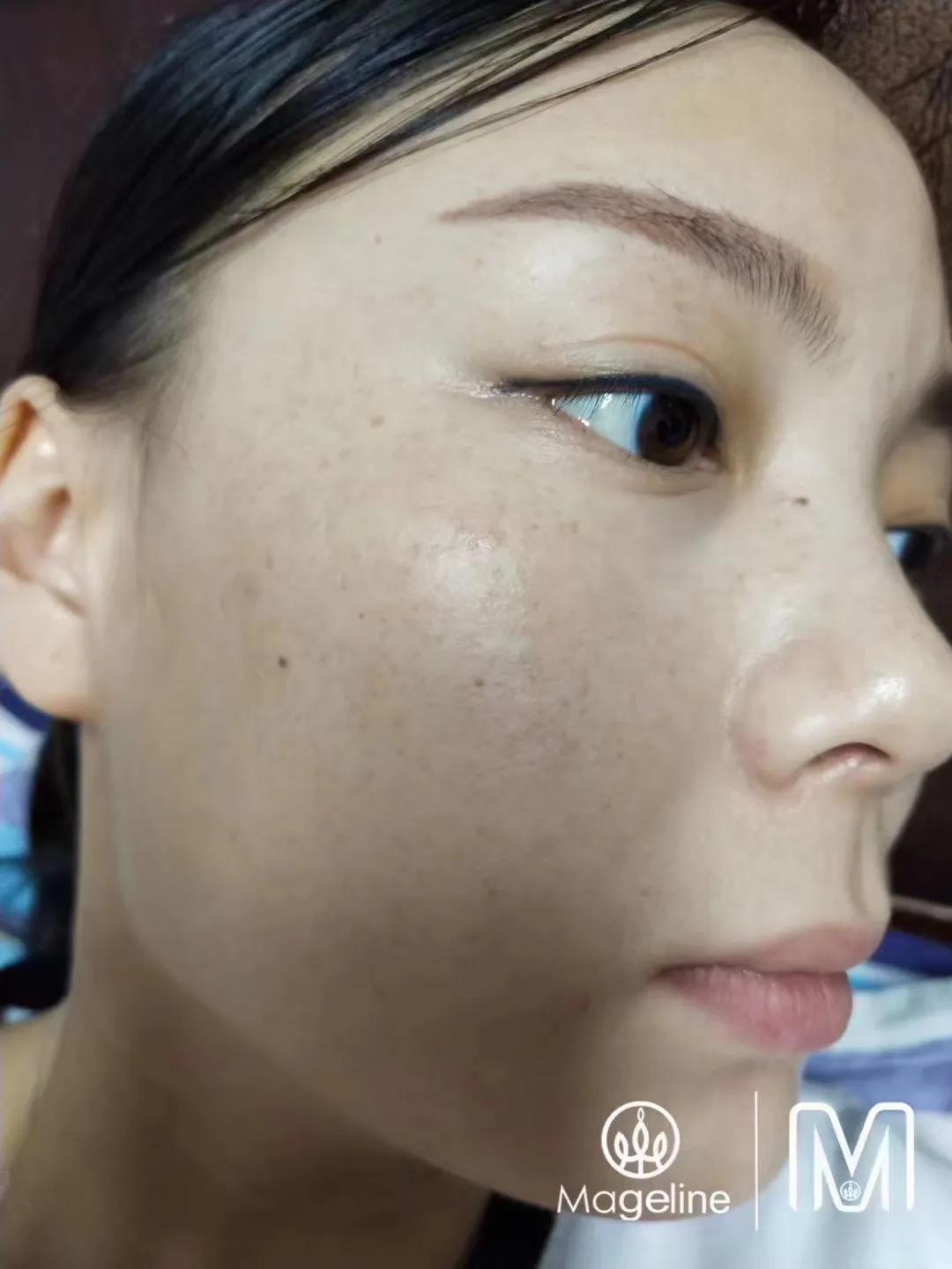 甜甜专业祛斑祛痘,甜甜祛斑直播间