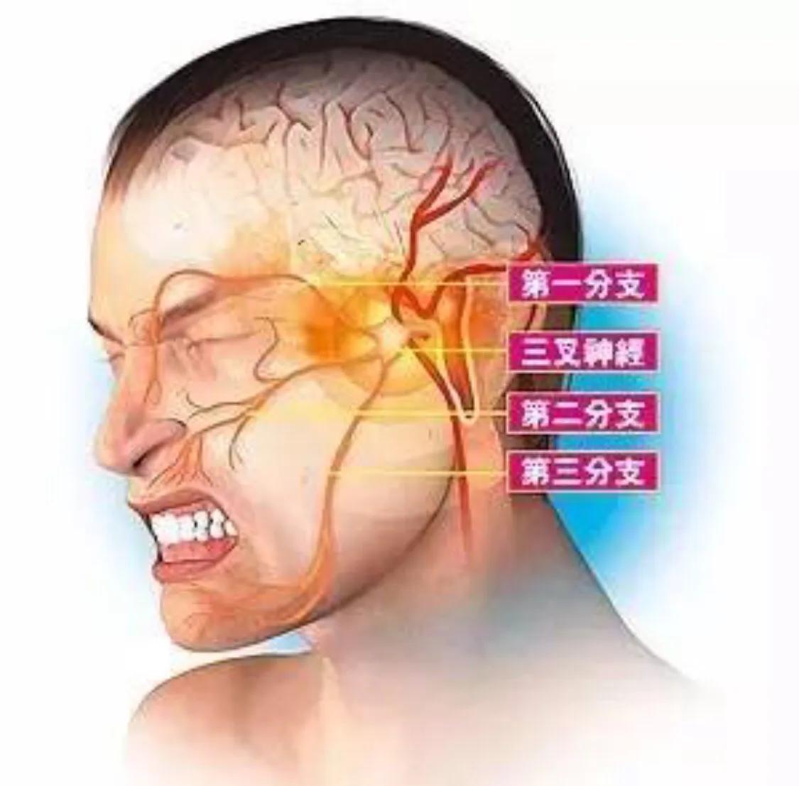 三叉神经痛偏方除根,三叉神经痛的最佳解决办法