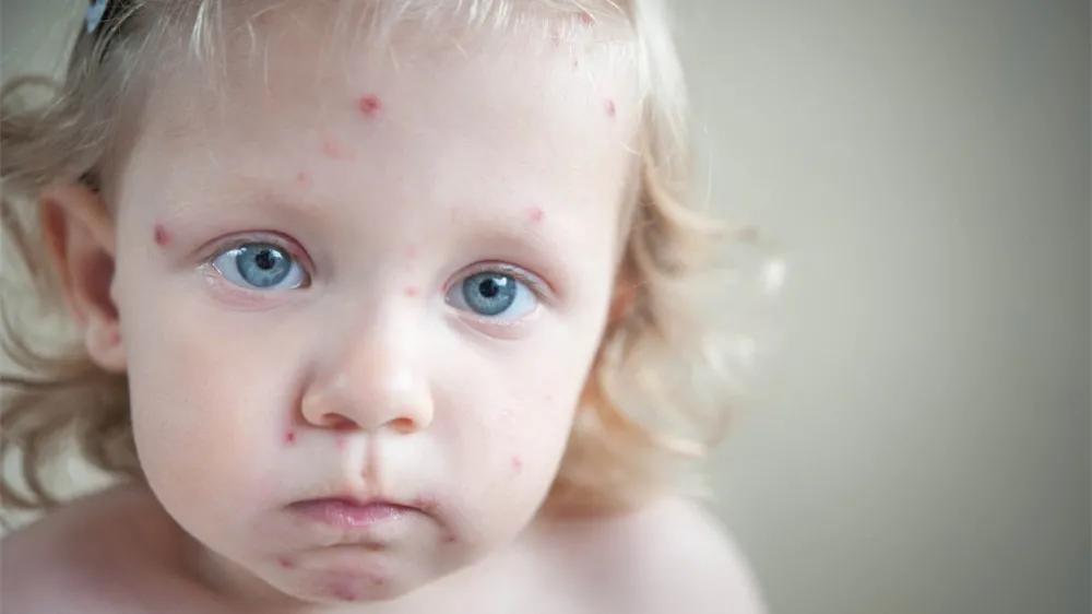 如何知道孩子是否患上1型糖尿病？