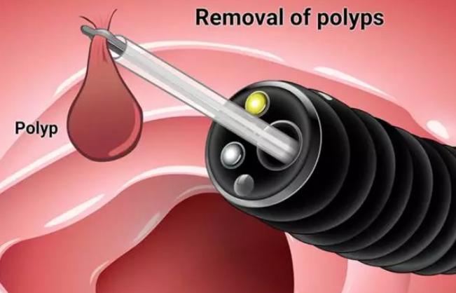 关于肠息肉的5个你最想知道的问题，权威解答来啦