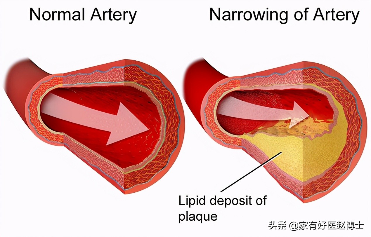 血压高低密度胆固醇3.3要吃他汀吗,血压高胆固醇高怎么降