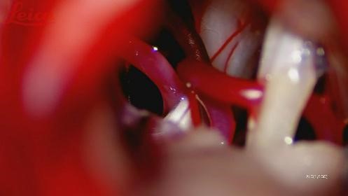 三叉神经痛需要抗癫痫治疗吗,癫痫引起的三叉神经痛怎么治疗