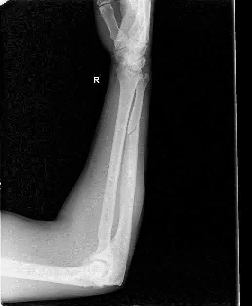 所有骨折都叫什么名字,骨折的名称有哪些