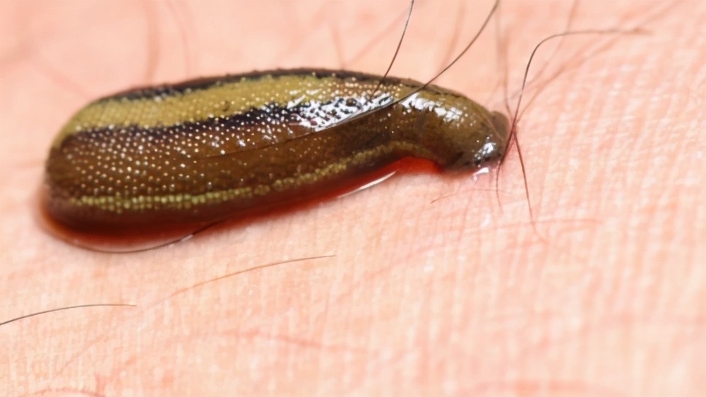 被水蛭咬了后怎么弄出来,水蛭被人吃进肚子里它能活多久