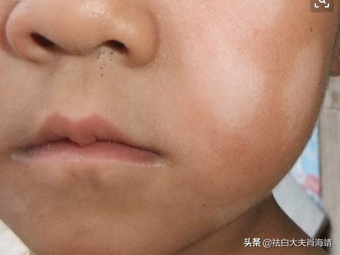 白癜风：6岁女童用劣质水彩笔在脸上画苹果？竟“洗”不掉了？