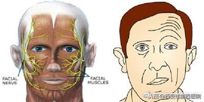 非典型面肌痉挛如何治疗,面肌痉挛最好的治疗方法