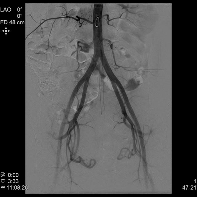 宫外孕保守治疗显示子宫腺肌症,子宫腺肌病保守治疗无效怎么办