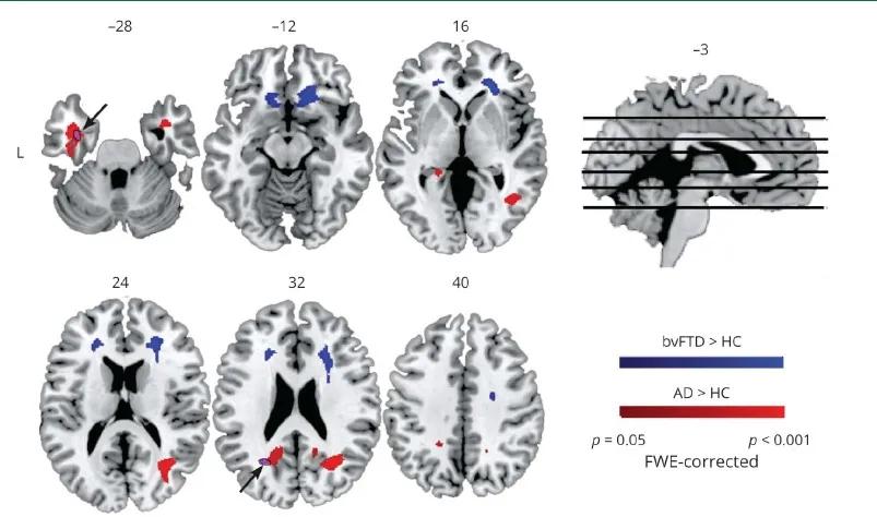 智力障碍成年人认知康复训练,智力障碍分级及预后
