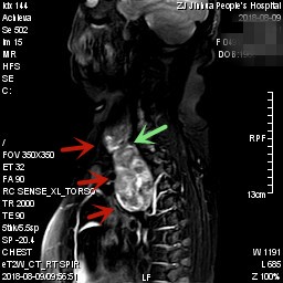 甲状腺肿瘤超大,胸骨后甲状腺肿病情是否很严重