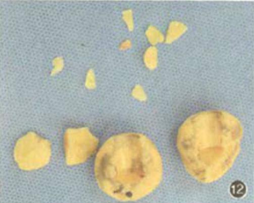 髋关节置换如何抗感染,骨科髋关节置换术后关注事项