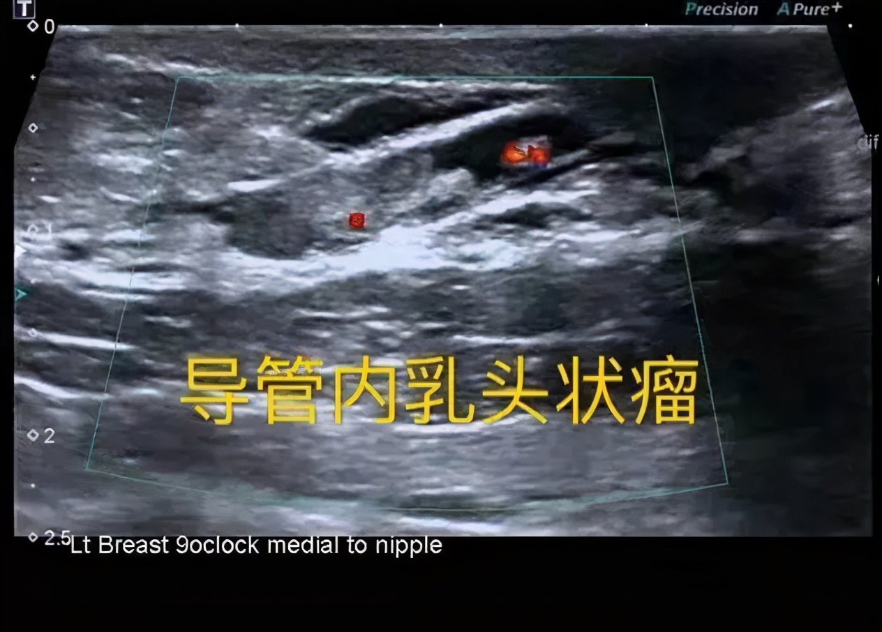 乳头“流水”，是乳腺癌吗？不可忽视的乳房信号