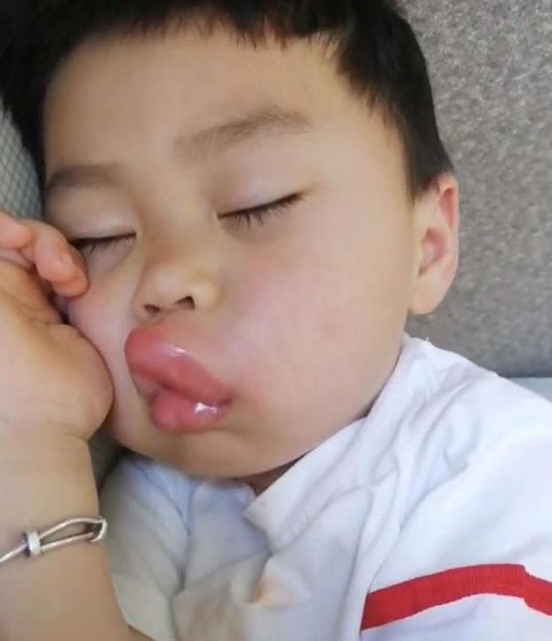 小孩上嘴唇突然肿成香肠嘴,小孩嘴巴突然肿大图片