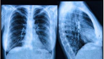 肺癌靶向药进口药有哪些,治疗肺癌的靶向药印度版的