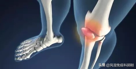中医风湿病的辨证论治,中医治疗风湿骨病的优势