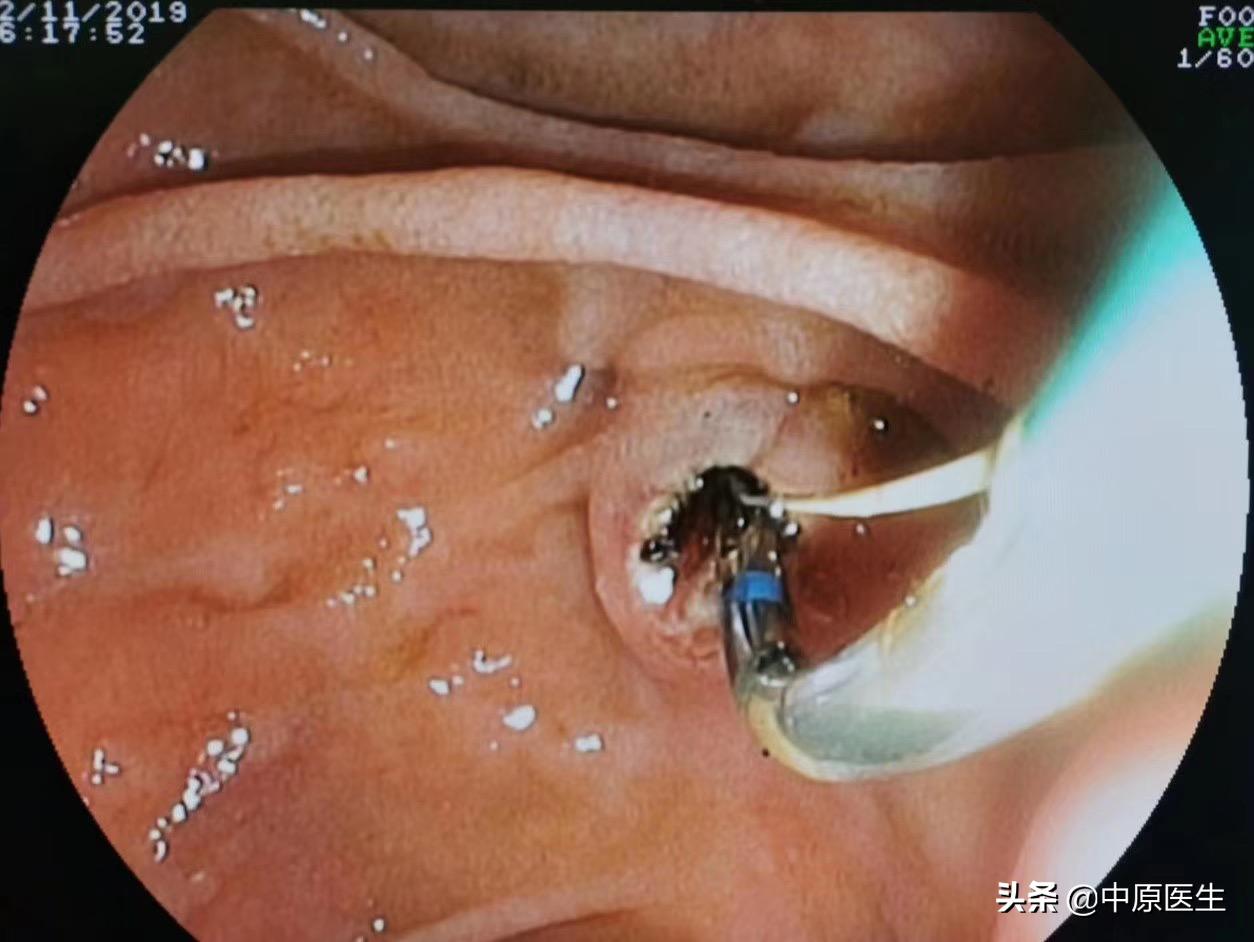 十二指肠与哪个器官对应,与十二指肠相邻的有哪些器官