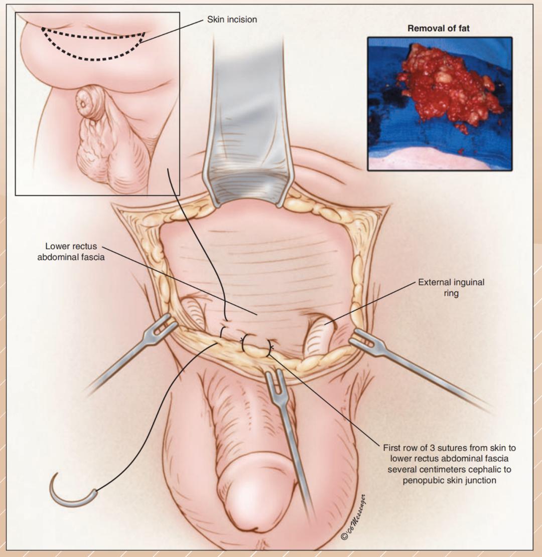 男人越胖能力越差吗,男性一胖胸部就肥大