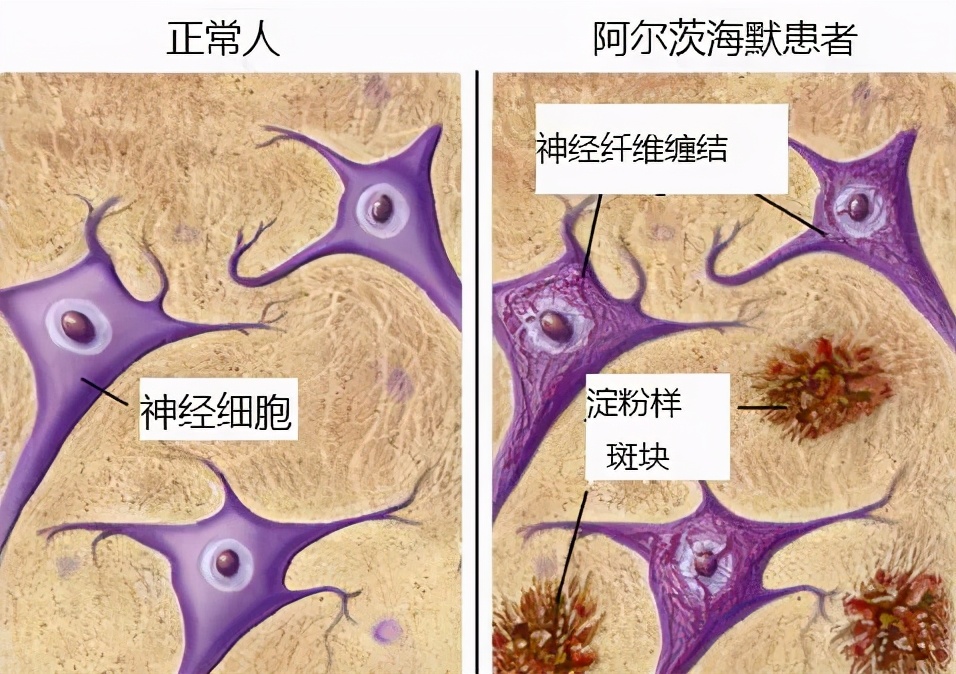 高血压大脑有什么影响,更年期高血压的症状和表现